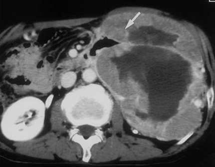嵌入器官征的启示