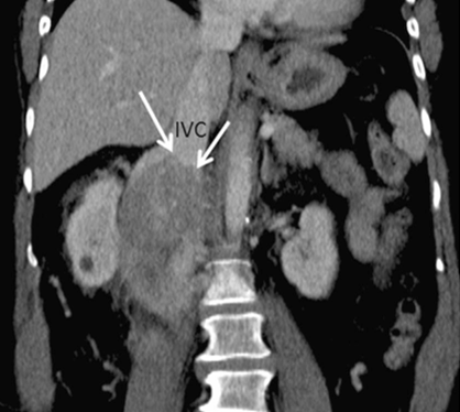 嵌入器官征的启示