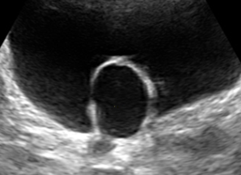 嵌入器官征的启示