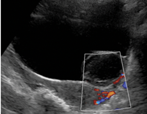 嵌入器官征的启示